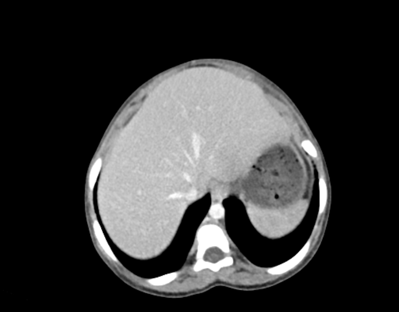 Abdominal premesenteric cystic lymphangioma (Radiopaedia 82995-97350 Axial C+ portal venous phase 4).jpg