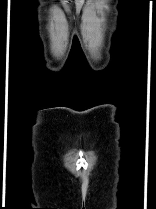 Abdominal wall and retroperitoneal tuberculosis (Radiopaedia 88137-104729 Coronal C+ portal venous phase 102).jpg