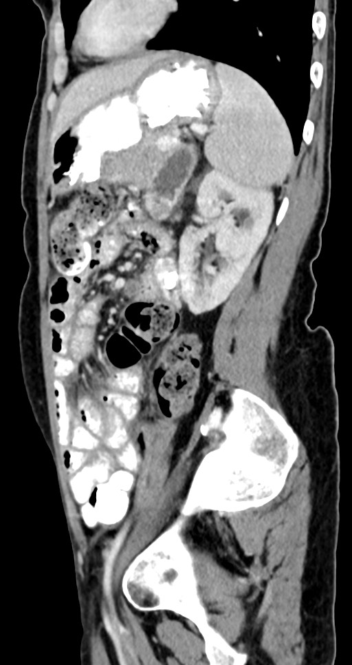Abdominal wall and retroperitoneal tuberculosis (Radiopaedia 88137-104729 Sagittal C+ portal venous phase 49).jpg
