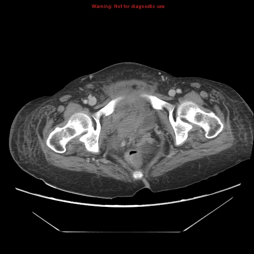 File:Abdominal wall hematoma (Radiopaedia 9427-10112 Axial C+ portal venous phase 105).jpg