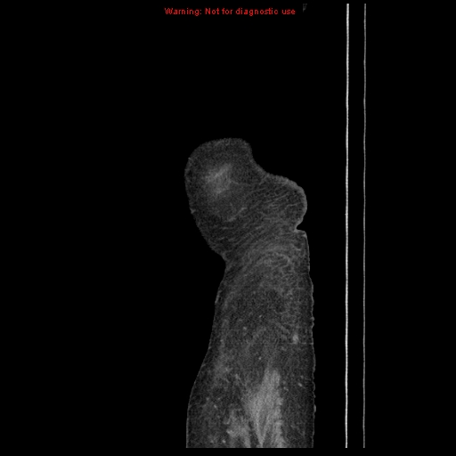 Abdominal wall hematoma (Radiopaedia 9427-10112 Sagittal C+ portal venous phase 4).jpg