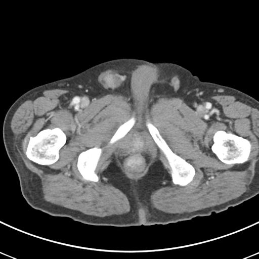 Abdominal wall metastasis from colorectal carcinoma (Radiopaedia 31016-31717 Axial C+ portal venous phase 81).jpg