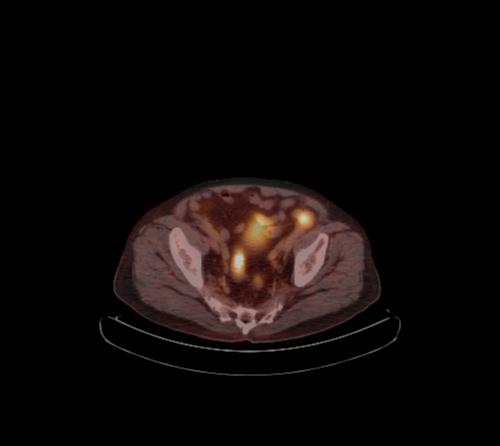 File:Abdominal wall metastasis from colorectal carcinoma (Radiopaedia 31016-31719 C 34).jpg