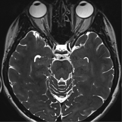 Abducens nerve palsy (Radiopaedia 51069-56648 Axial T2 fat sat 58).png