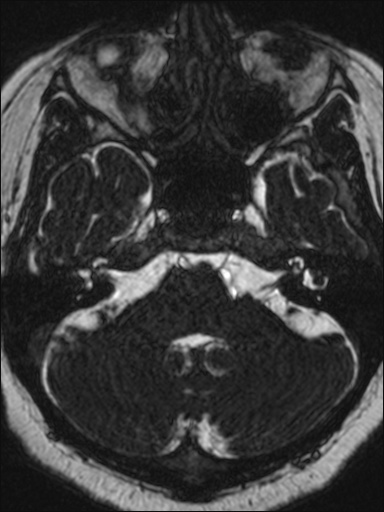 Abducens nerve palsy (Radiopaedia 57084-63976 Axial T2 ciss 3d 24).jpg