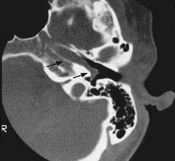 File:Aberrant internal carotid artery (Radiopaedia 22266-22303 Axial bone window 1).jpg