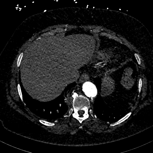 File:Aberrant right subclavian artery with Kommerell diverticulum (Radiopaedia 47982-52769 Axial C+ arterial phase 80).png