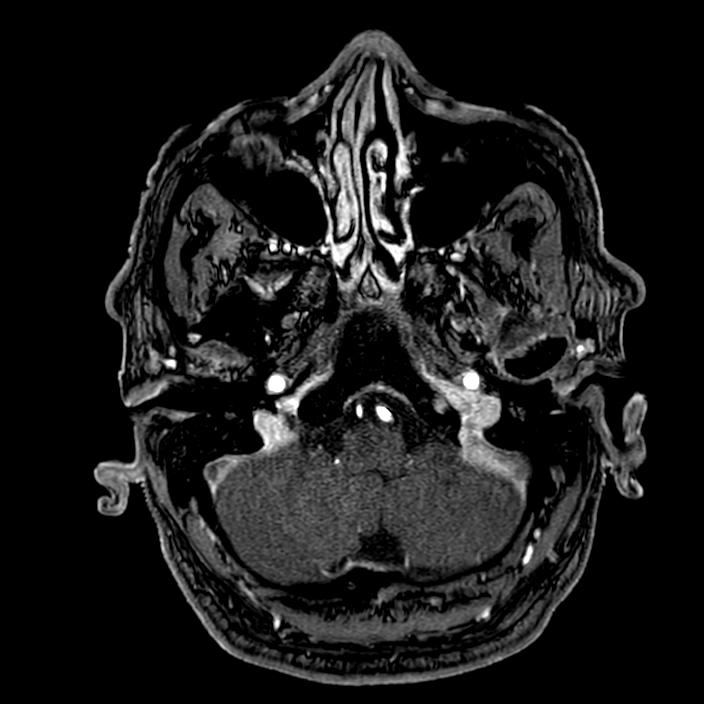 Accessory middle cerebral artery (Radiopaedia 73114-83828 Axial MRA 17).jpg