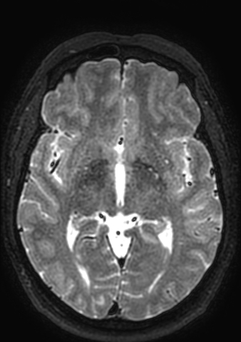 Accessory middle cerebral artery (Radiopaedia 73114-83828 Axial T2 87).jpg