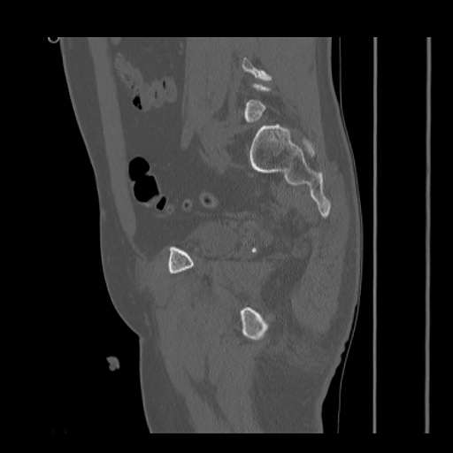 Acetabular and ilial fractures (Radiopaedia 59084-66378 Sagittal bone window 63).jpg