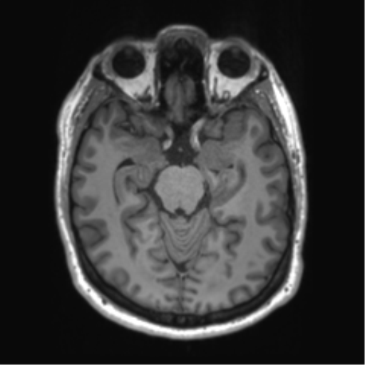 File:Achondroplasia (Radiopaedia 65109-74105 Axial T1 35).png