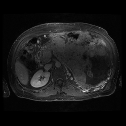Acinar cell carcinoma of the pancreas (Radiopaedia 75442-86668 Axial T1 C+ fat sat 59).jpg