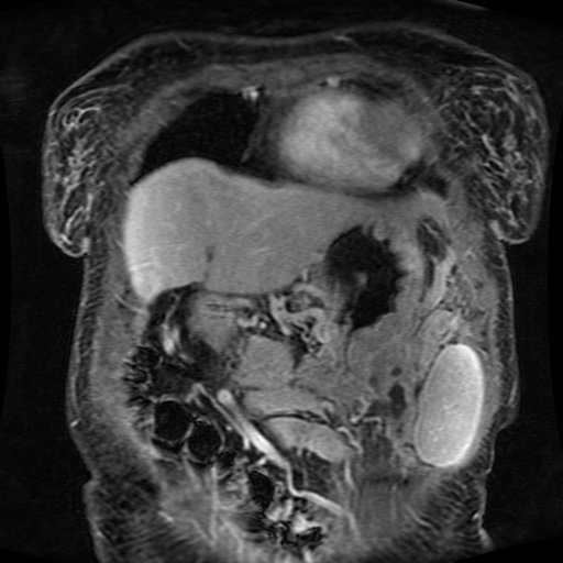 Acinar cell carcinoma of the pancreas (Radiopaedia 75442-86668 Coronal T1 C+ fat sat 150).jpg