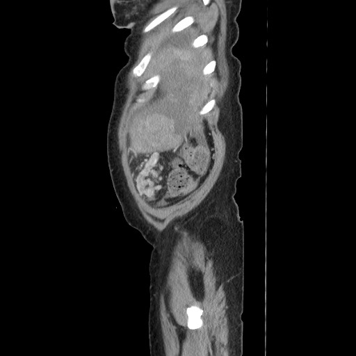 Acinar cell carcinoma of the pancreas (Radiopaedia 75442-86669 Sagittal C+ portal venous phase 174).jpg