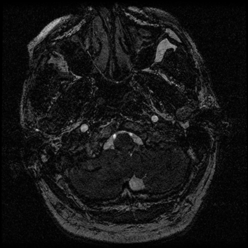 File:Acoustic schwannoma (Radiopaedia 39170-41387 Axial FIESTA 16).png