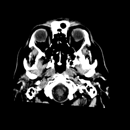 File:Acoustic schwannoma (Radiopaedia 55729-62280 Axial non-contrast 5).png