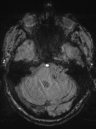 Acoustic schwannoma (Radiopaedia 55729-62281 Axial SWI 13).png