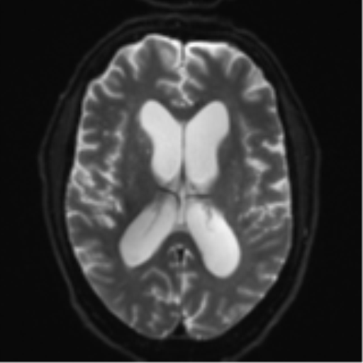 Acoustic schwannoma (Radiopaedia 55729-62281 E 15).png