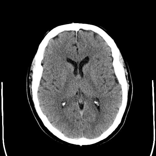 File:Acoustic schwannoma - cystic (Radiopaedia 29487-29980 AXIAL THICK non-contrast 15).jpg