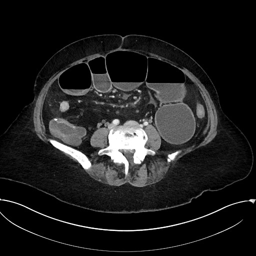Active Crohn disease (Radiopaedia 59394-66750 Axial C+ portal venous phase 46).jpg
