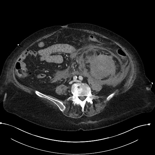 File:Active renal extravasation with large subcapsular and retroperitoneal hemorrhage (Radiopaedia 60975-68796 Axial 232).jpg
