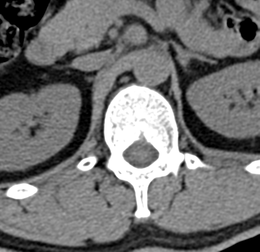 File:Acute L1 burst compression fracture (Radiopaedia 34430-35755 Axial non-contrast 13).png