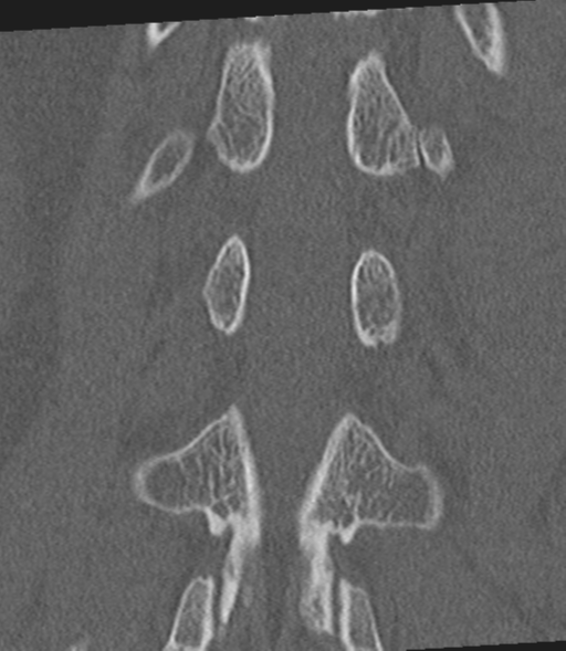 File:Acute L1 burst compression fracture (Radiopaedia 34430-35755 Coronal bone window 41).png