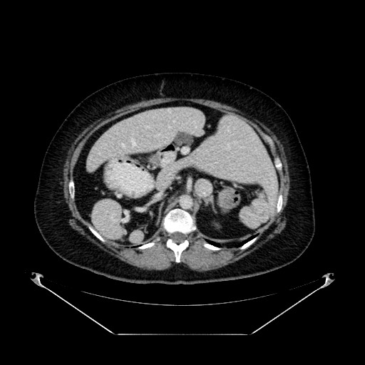 Acute appendicitis, heterotaxy syndrome (Radiopaedia 66884-76202 Axial C+ portal venous phase 40).jpg