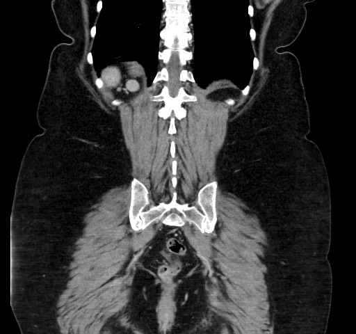 Acute appendicitis, heterotaxy syndrome (Radiopaedia 66884-76202 Coronal C+ portal venous phase 101).jpg