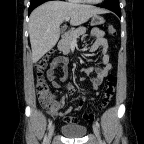 File:Acute appendicitis (Radiopaedia 38255-40270 Coronal C+ portal venous phase 35).jpg
