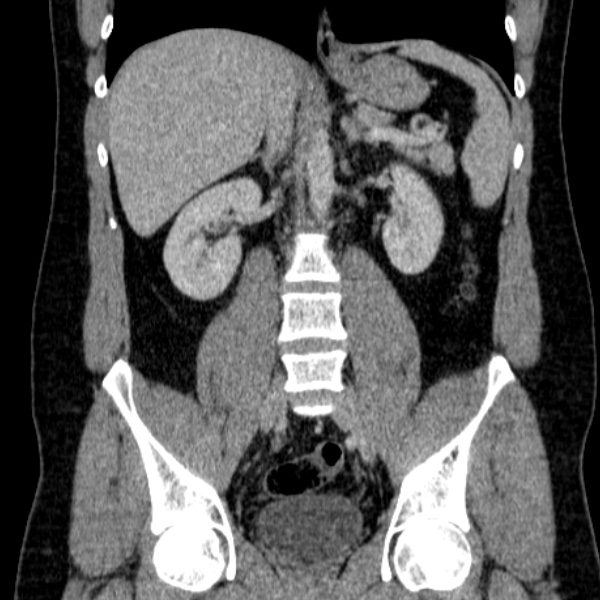 Acute appendicitis (Radiopaedia 38255-40270 Coronal C+ portal venous phase 50).jpg