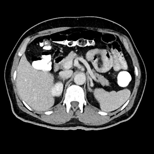 Acute appendicitis (Radiopaedia 77016-88960 Axial C+ portal venous phase 45).jpg