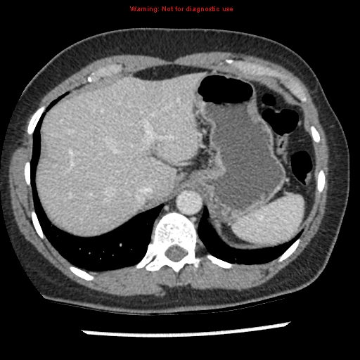 Acute appendicitis (Radiopaedia 7966-8812 C+ portal venous phase 2).jpg