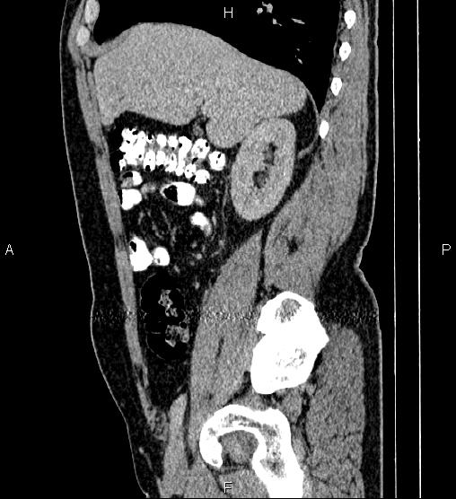 File:Acute appendicitis (Radiopaedia 84780-100240 Sagittal C+ portal venous phase 31).jpg