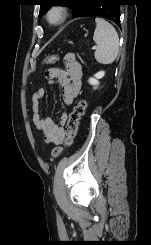 Acute appendicitis - large appendicoliths (Radiopaedia 61805-69820 Sagittal C+ portal venous phase 25).jpg