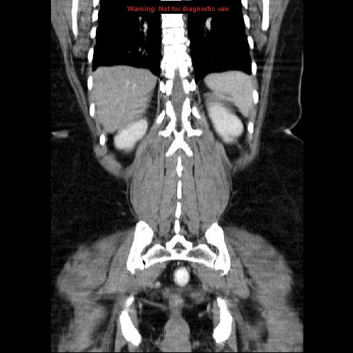 Acute appendicitis complicated by ovarian vein thrombophlebitis (Radiopaedia 16172-15851 Coronal C+ portal venous phase 64).jpg