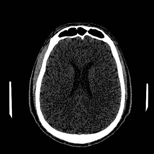 Acute basilar artery occlusion (Radiopaedia 43582-46985 Axial non-contrast 111).jpg