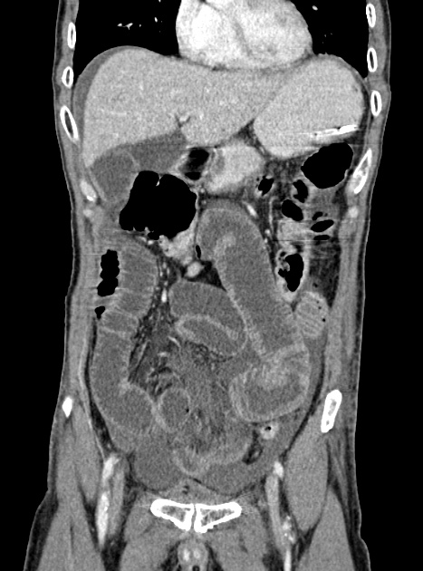 Acute bowel ischemia (Radiopaedia 87695-104114 Coronal C+ portal venous phase 148).jpg