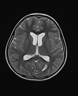 File:Acute cerebellar ataxia (Radiopaedia 61487-69446 Axial T2 13).jpg