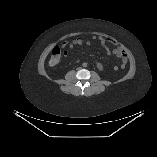 Acute cholecystitis with tensile fundus sign (Radiopaedia 71394-81723 Axial non-contrast 58).jpg