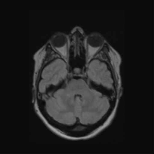 Acute disseminated encephalomyelitis (ADEM) (Radiopaedia 38073-40065 Axial FLAIR 16).png