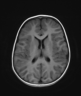 File:Acute disseminating encephalomyelitis with bilateral optic neuritis (Radiopaedia 79676-92886 Axial T1 15).jpg