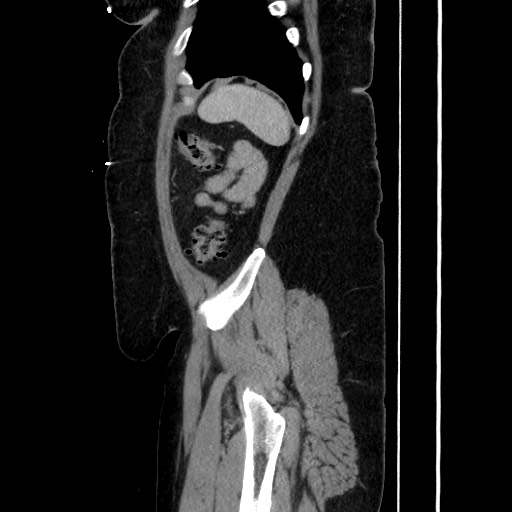 Acute diverticulitis - transverse colon (Radiopaedia 87063-103327 Sagittal C+ portal venous phase 181).jpg