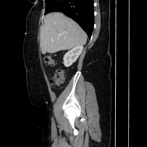 Acute diverticulitis - transverse colon (Radiopaedia 87063-103327 Sagittal C+ portal venous phase 80).jpg