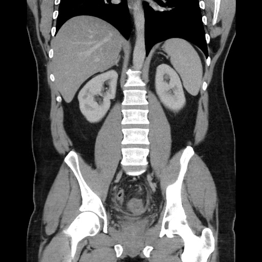 Acute diverticulitis with localized perforation (Radiopaedia 41296-44113 Coronal C+ portal venous phase 40).jpg