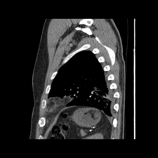 Acute epicardial fat necrosis (Radiopaedia 42327-45440 Sagittal C+ CTPA 58).jpg