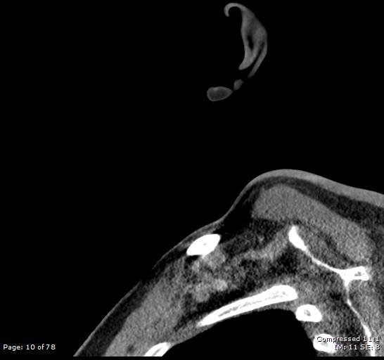 Acute epiglottitis (Radiopaedia 54375-60590 Sagittal C+ arterial phase 10).jpg
