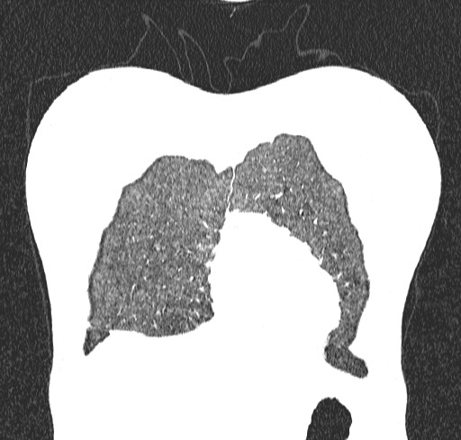 Acute hypersensitivity pneumonitis (Radiopaedia 85293-100870 Coronal lung window 10).jpg