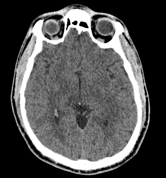 Acute ischemic stroke - posterior circulation territory (Radiopaedia 77670-89881 non-contrast 41).jpg