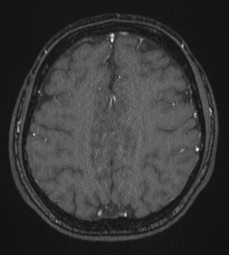 Acute left middle cerebral artery territory infarct with clot retrieval (Radiopaedia 47732-52433 Axial MRA 49).png